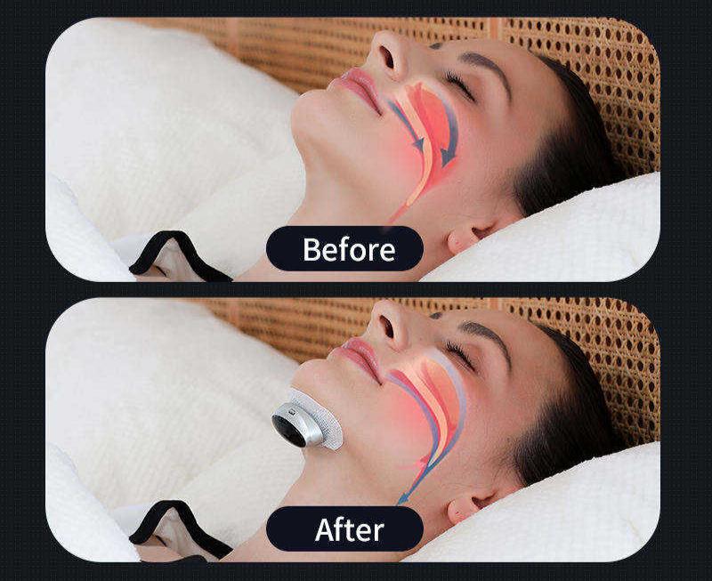 Comfortable silicone AirEase nasal clip, soft anti-snore device for peaceful sleep apnea relief.