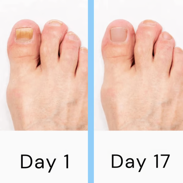 Advanced at-home laser therapy device for comprehensive nail fungus removal. Restores healthy nails & enhances foot care.