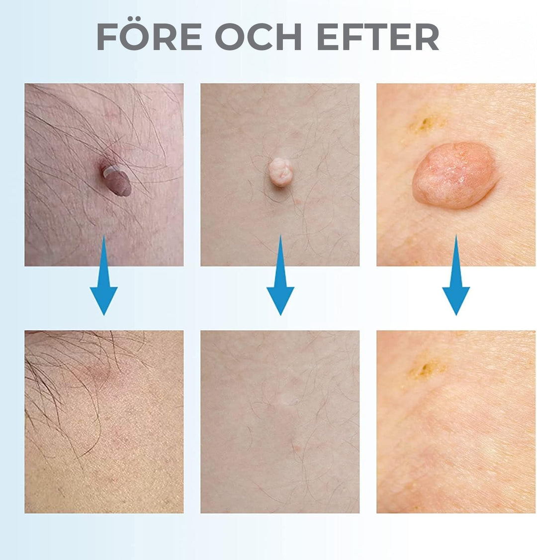 Professional at-home skin tag, mole, and wart removal kit for safe and easy blemish treatment & body care.