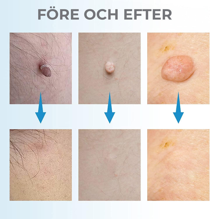Professional at-home skin tag, mole, and wart removal kit for safe and easy blemish treatment & body care.