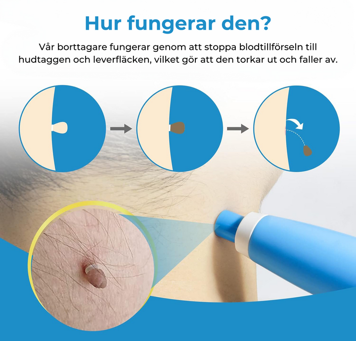 Comprehensive at-home skin blemish remover for effective wart, mole, and skin tag removal. Achieve smooth, clear skin.