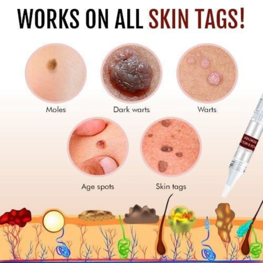 Applying natural skin tag & mole remover for clear skin. Easy at-home treatment for blemishes.