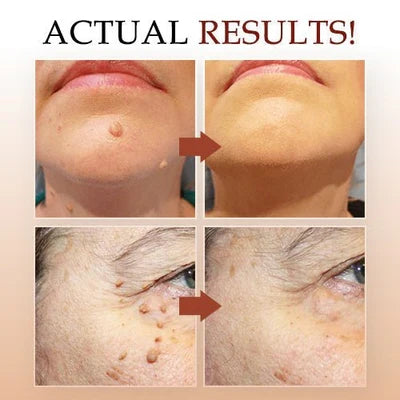 Tea tree oil in our natural skin tag & mole remover. Powerful plant-based solution for clear, healthy skin.