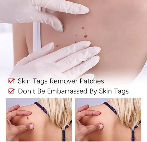At-home skin care with natural skin tag & mole remover. Achieve clear skin easily, a gentle blemish corrector.