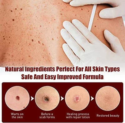Instructions for using the at-home skin tag & mole remover. Simple steps for effective blemish removal & clear skin.