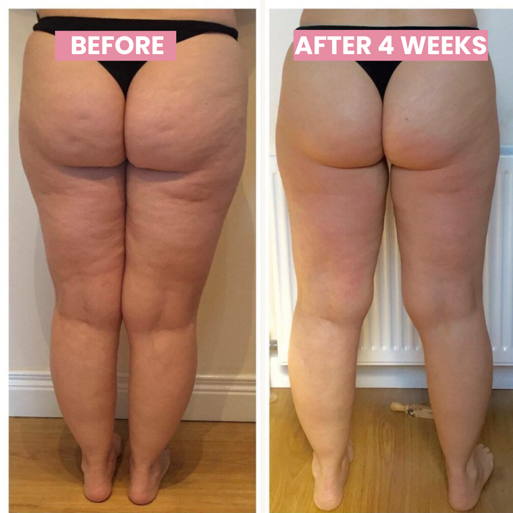 Infrared cupping therapy device for cellulite reduction, skin firming, and lymphatic drainage.