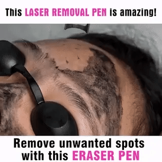 At-home beauty device: Laser pen for pigment reduction, mole, & freckle removal.