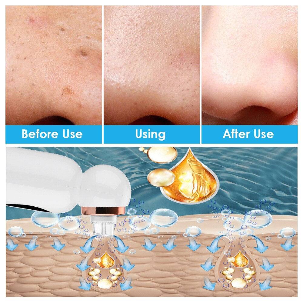 Portable HydraGlow blackhead remover and hydrodermabrasion device for comprehensive facial skincare and pore treatment.