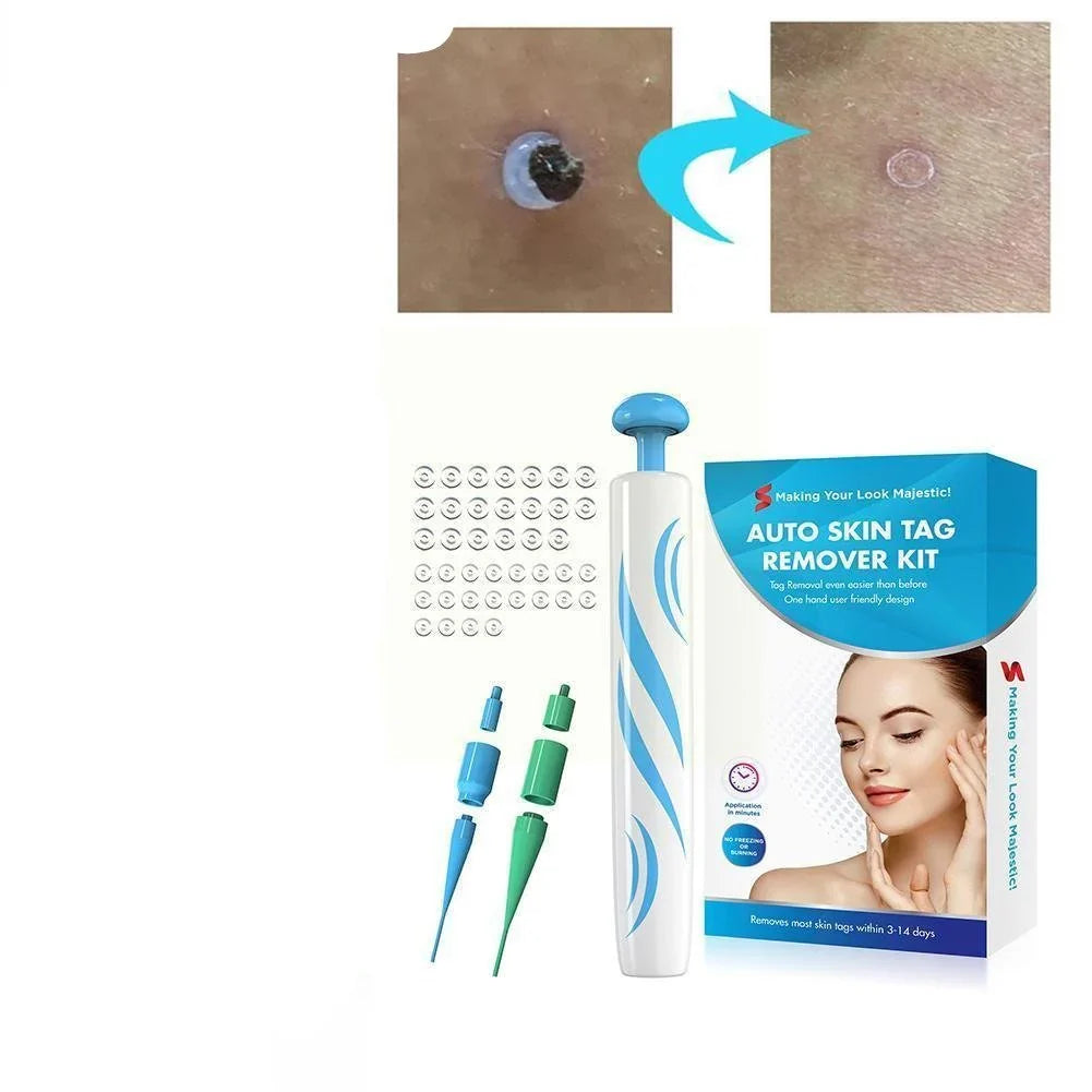 Painless Auto Skin Tag Remover Kit for easy home treatment, achieving clear, blemish-free skin. Skincare solution.