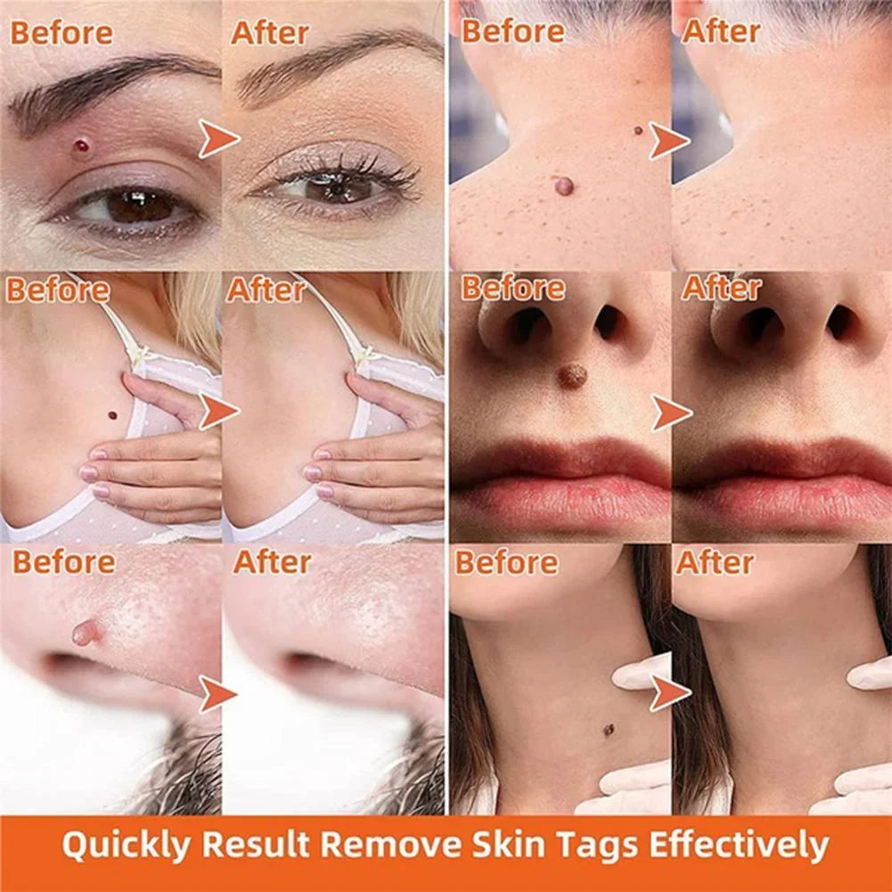 Close-up of the Auto Skin Tag Remover Kit, designed for painless, effective blemish removal and clear skin.