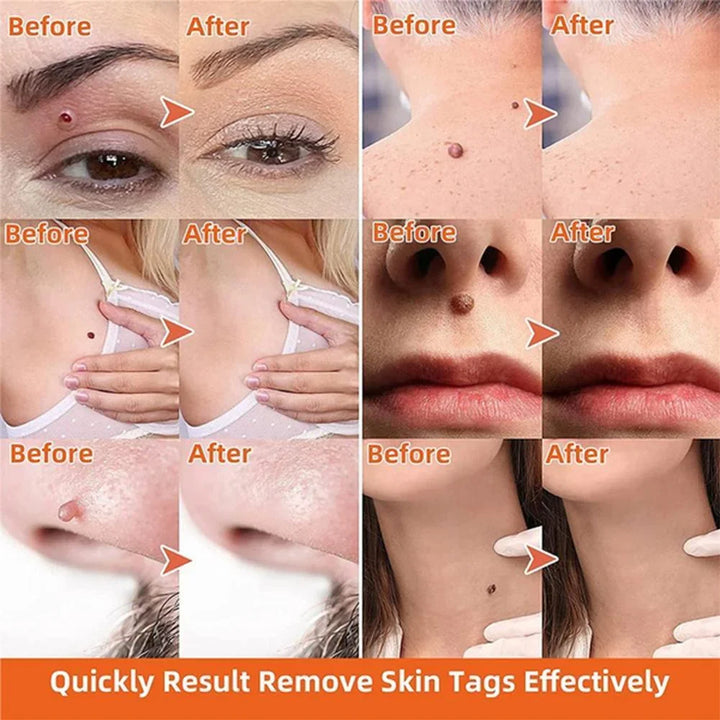 Close-up of the Auto Skin Tag Remover Kit, designed for painless, effective blemish removal and clear skin.