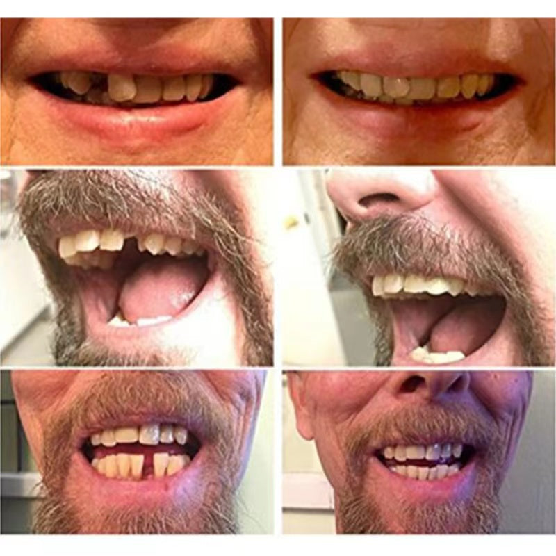 Dental cover for instant smile. High-quality temporary false teeth veneers, perfect for a quick tooth fix & confidence.