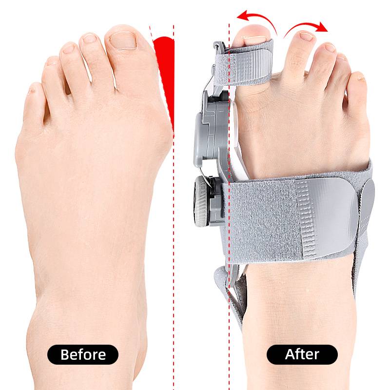 Adjustable bunion splint & toe spacer provides targeted foot pain relief & support.