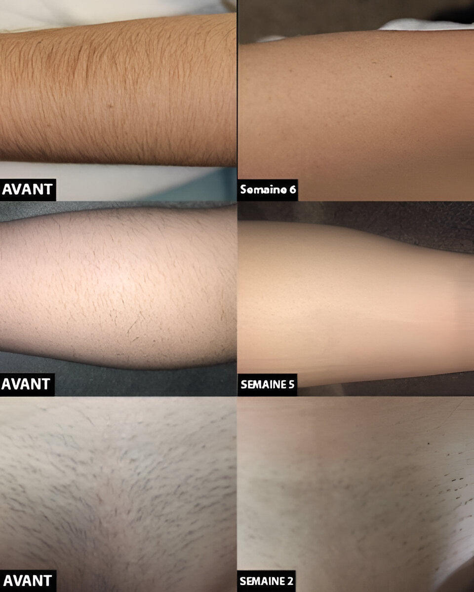 Women's personal care laser hair removal device, providing long-lasting smooth skin & effective hair reduction at home.