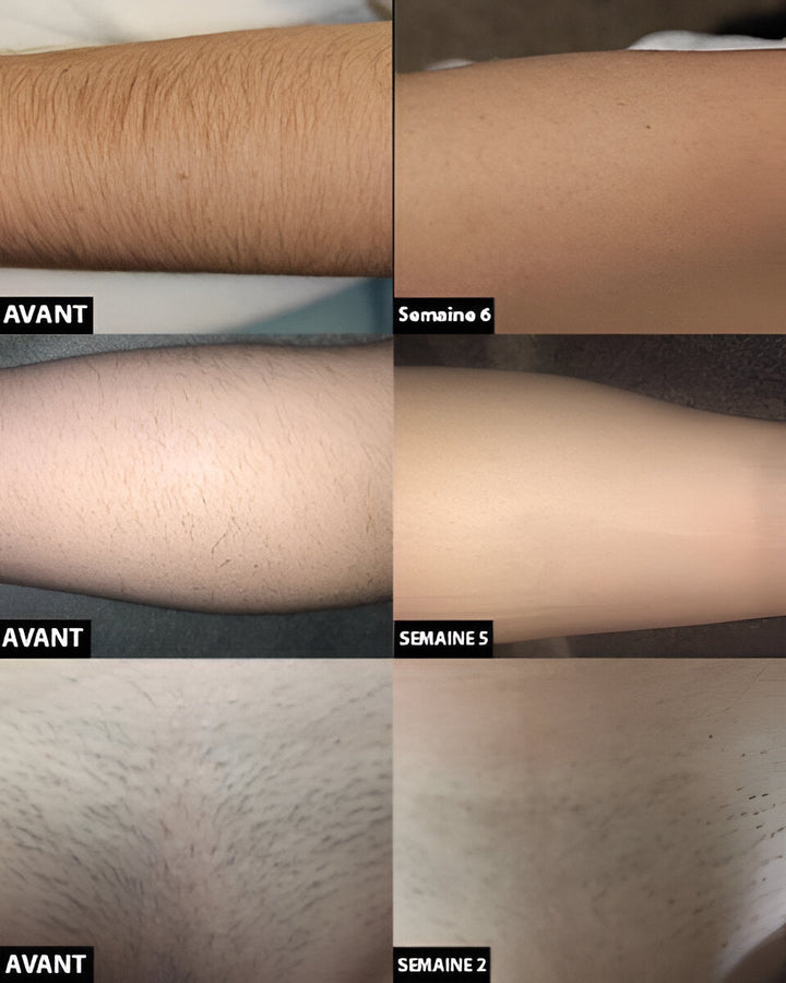 Women's personal care laser hair removal device, providing long-lasting smooth skin & effective hair reduction at home.